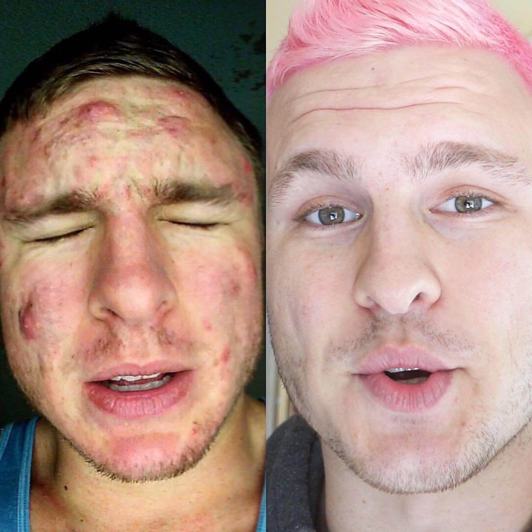 Watch This Man's Vegan AcneClearing Success Story PETA