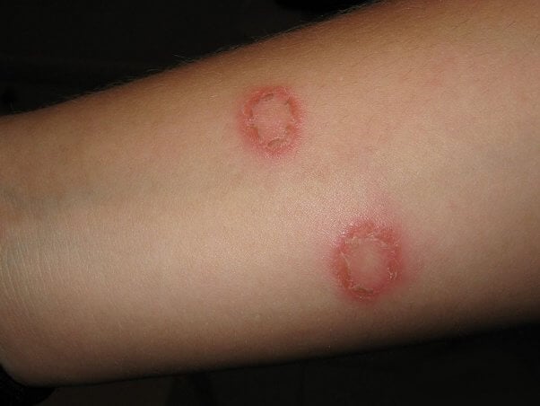 2 lesions associated with ringworm on the forearm