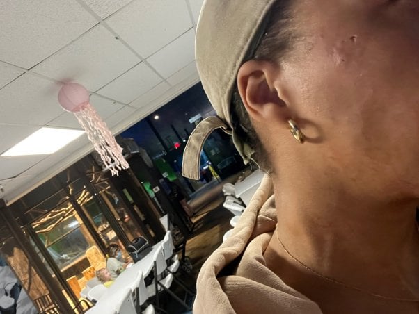 woman with a scratch on the side of her face after visiting the Austin Aquarium