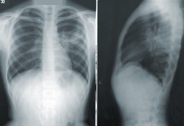 xray showing human lungs with pneumonia